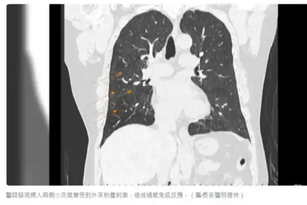 Diagnosed with flour bag lung after prolonged exposure to flour.